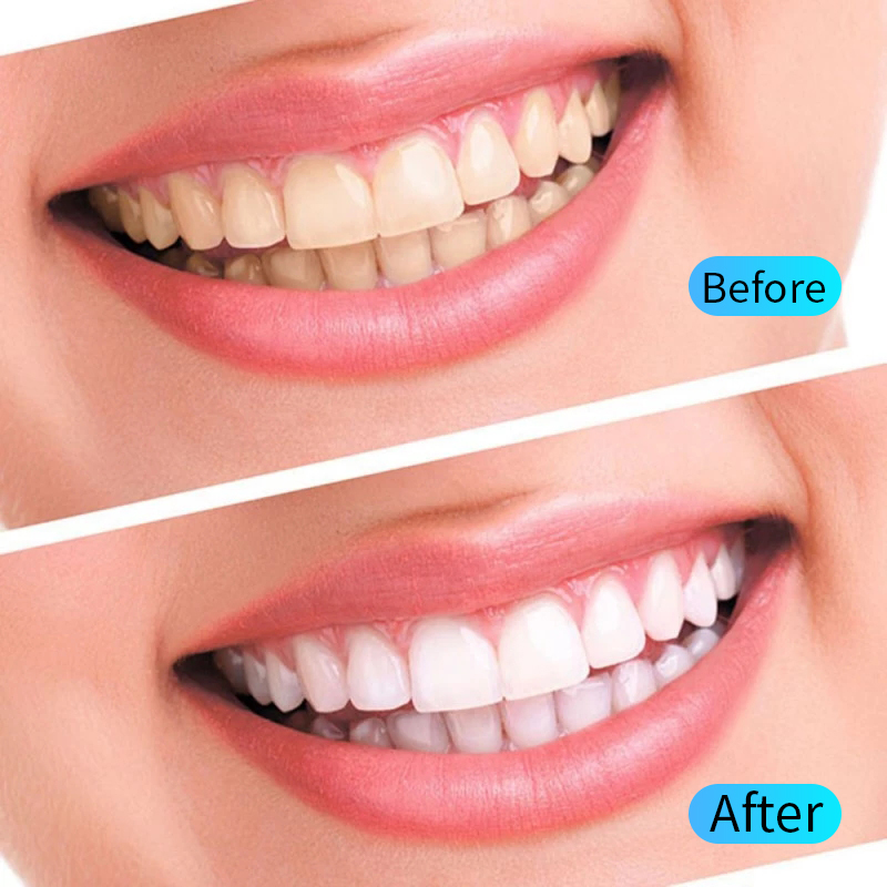 Teeth Whitening Gel Kit Oral H - Teeth Whitening Kit At Home ulasan dan harga