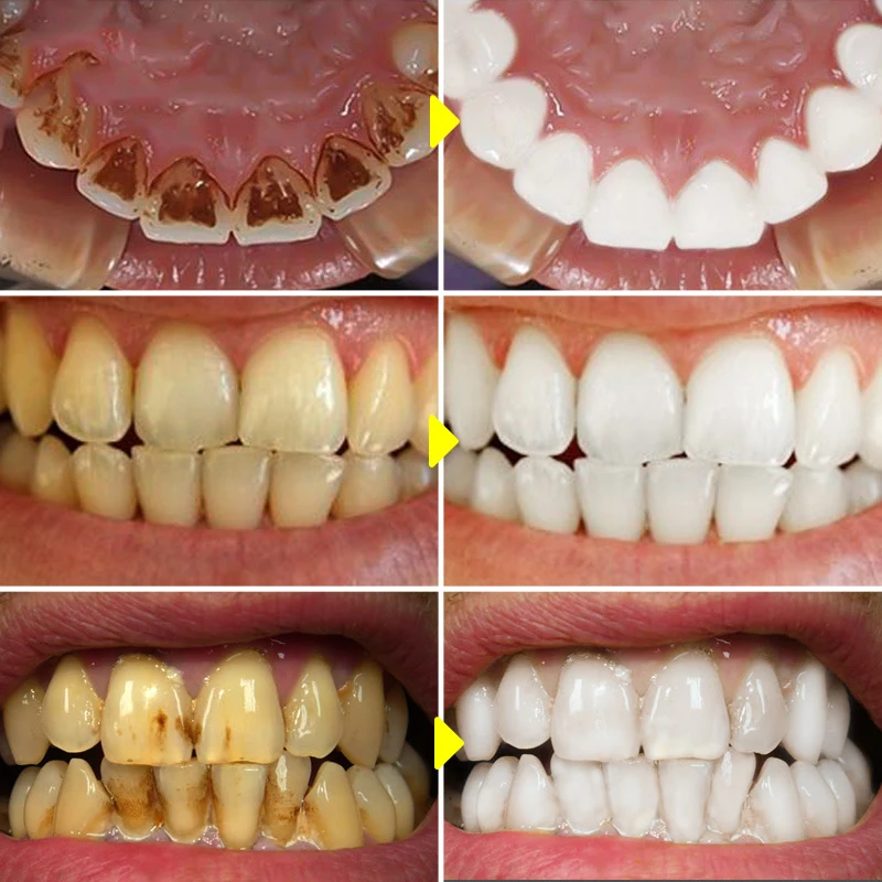 V34 Teeth Whitening Mousse Too - Teeth Whitening/Bleaching ulasan dan harga