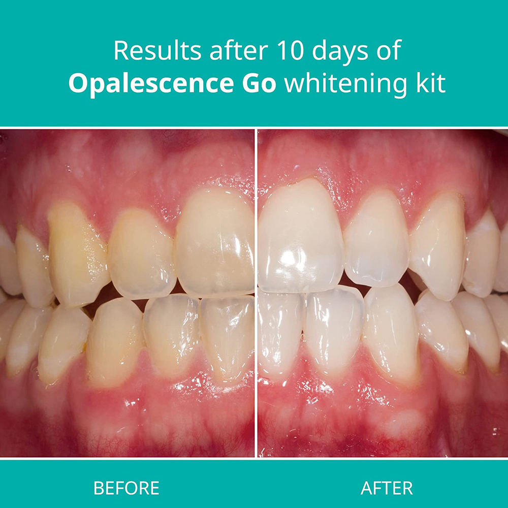 Opalescence Go Teeth Whitening - Teeth Whitening Kit At Home ulasan dan harga